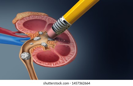 Kidney Stones and How They Are Removed